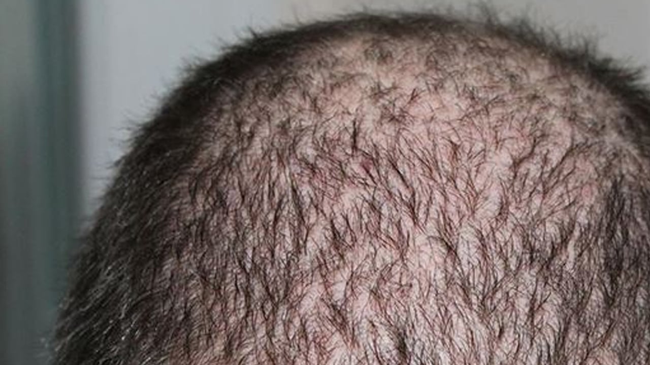 Foto - Saç dökülmesini hızlıca kesiyor: Bu yiyecek saç dökülmesini anında durduruyor! Büyük bir etkiye sahip olduğu biliniyor!