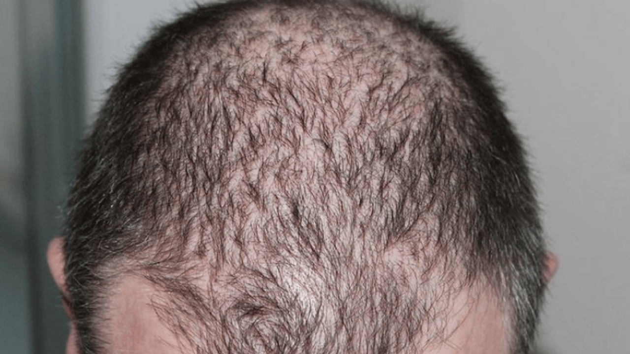 Saç dökülmesini tetikleyen en önemli alışkanlık! Uzman ismini duyurdu... Kimse farkında değil