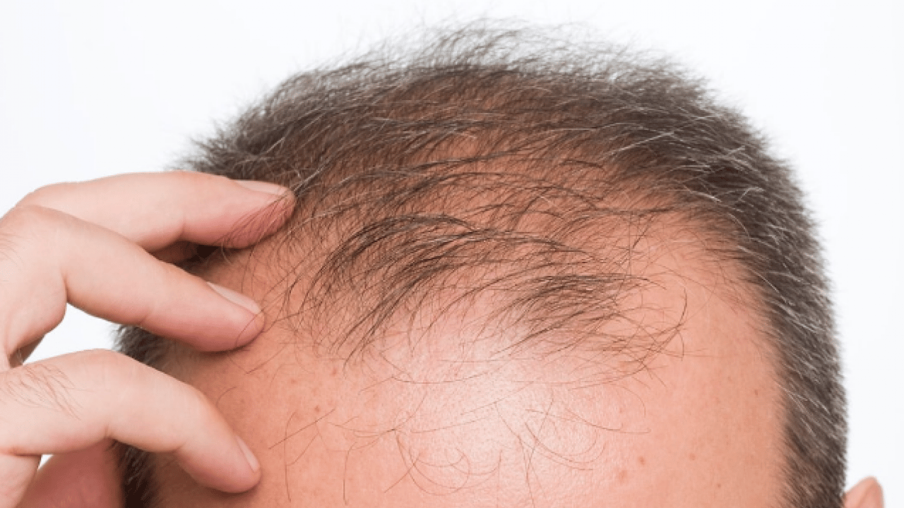 Foto - Saç dökülmesini tetikleyen en önemli alışkanlık! Uzman ismini duyurdu... Kimse farkında değil