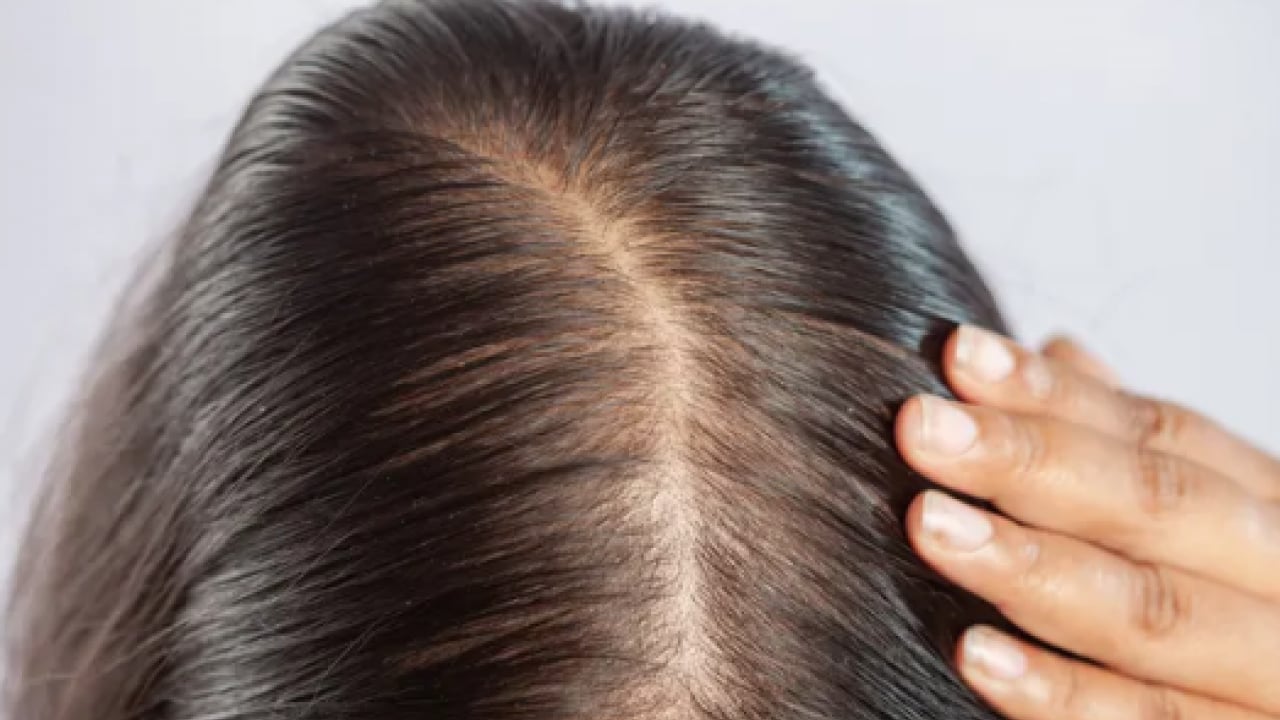 Foto - Saç seyrelmesinin sinsi habercilerine dikkat artık! Yetersiz protein ve vitamin...