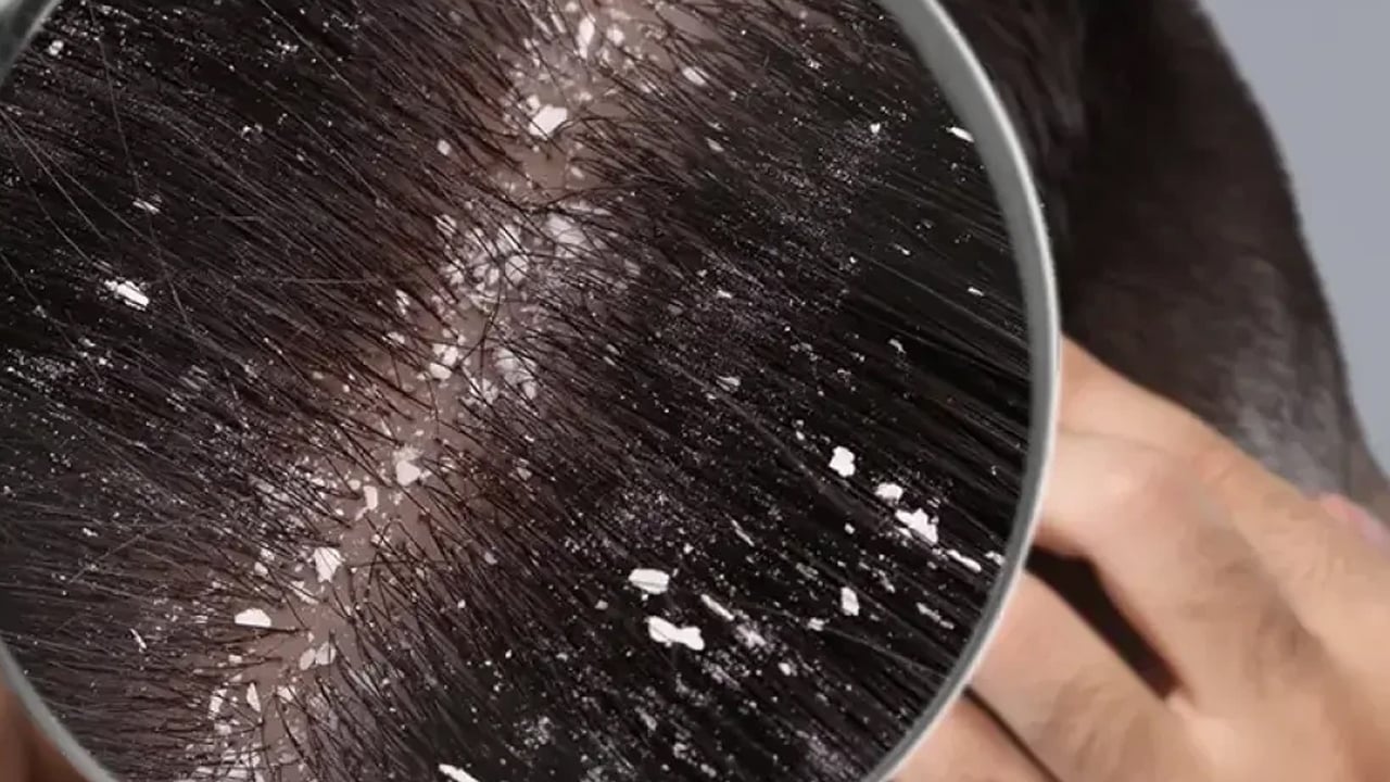 Foto - Saç yıkamak kepek oluşumuna davetiye çıkarıyor: Saç sağlığına ve saça riskleri nelerdir? Gizli tehlike ortaya çıktı