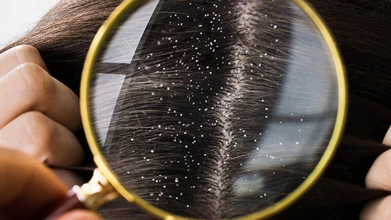 Foto - Saç yıkamak kepek oluşumuna davetiye çıkarıyor: Saç sağlığına ve saça riskleri nelerdir? Gizli tehlike ortaya çıktı