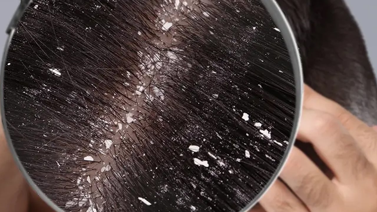 Foto - Saç yıkamak kepek oluşumuna davetiye çıkarıyor: Saç sağlığına ve saça riskleri nelerdir? Gizli tehlike ortaya çıktı