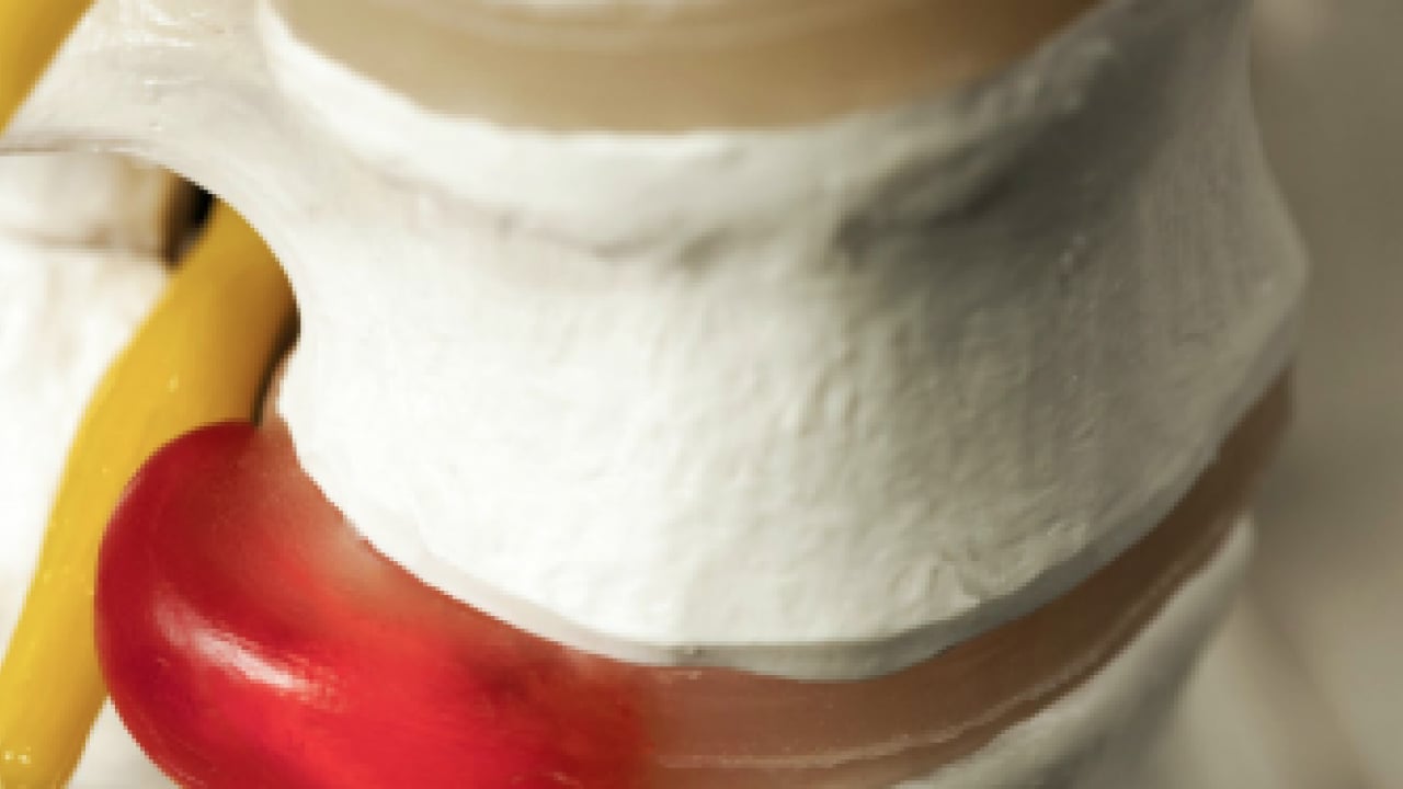 Foto - Sadece diske müdahale yeterli değil: Bel ve boyun fıtığı hastalarına önemli tavsiyeler...