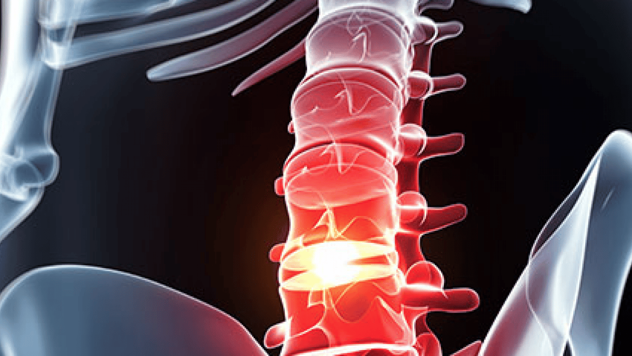 Foto - Sadece diske müdahale yeterli değil: Bel ve boyun fıtığı hastalarına önemli tavsiyeler...