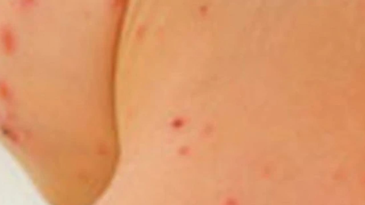 Foto - Salgın alarmı! Hızla yayılıyor! Kalabalık ortamlardan uzak durun