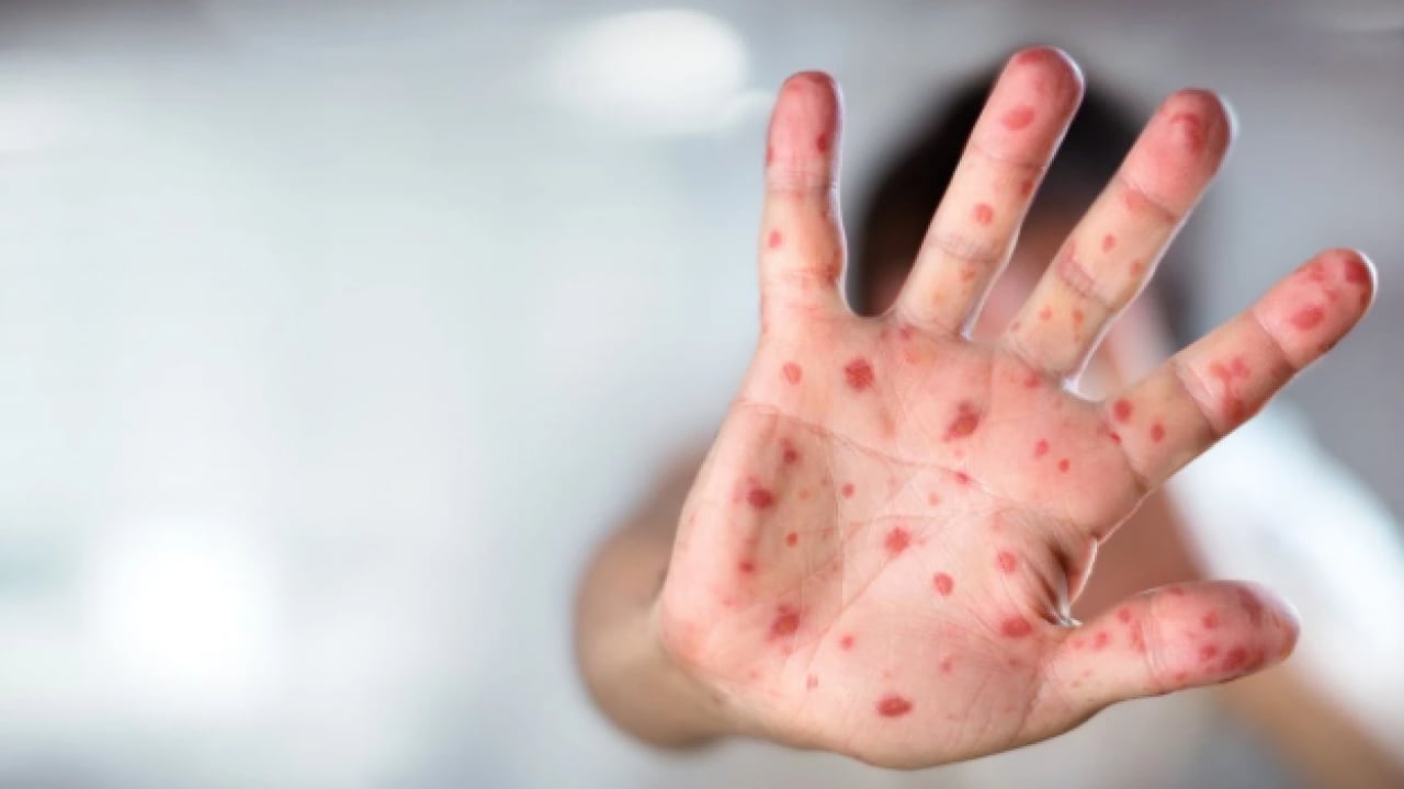 Foto - Salgın alarmı! Hızla yayılıyor! Kalabalık ortamlardan uzak durun