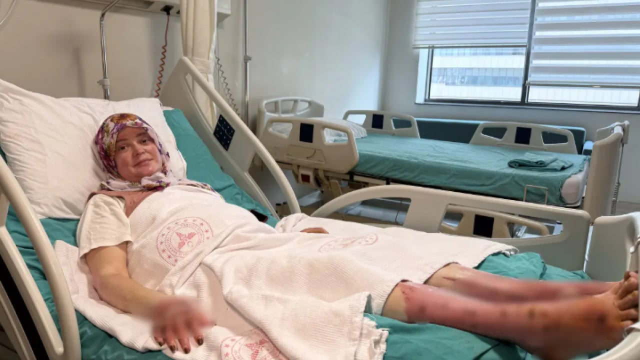 Foto - Satın almadan önce iki kez düşünün: Vücudunun yüzde 70'i yandı!