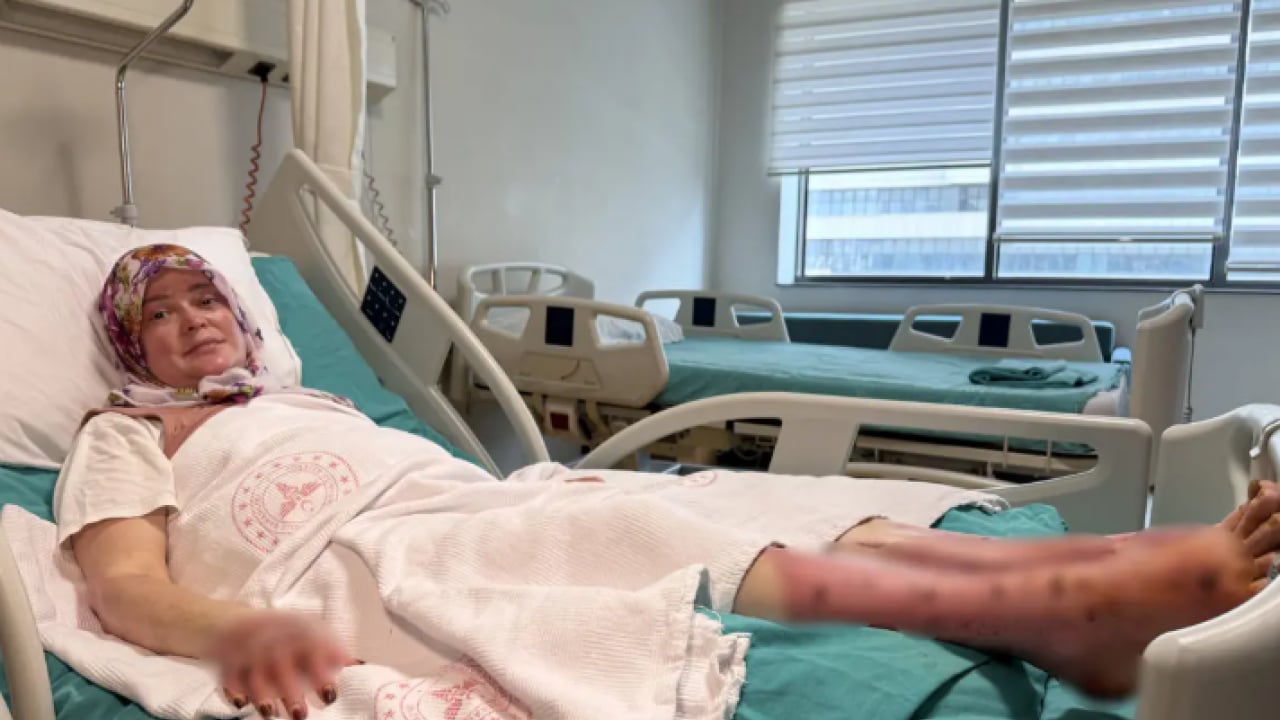 Foto - Satın almadan önce iki kez düşünün: Vücudunun yüzde 70'i yandı!