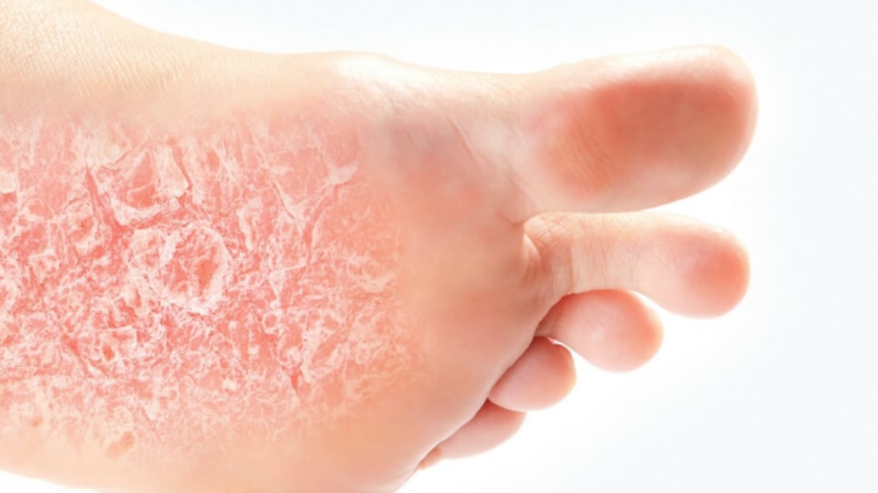 Foto - Şeker mekanizmasını bilim insanları keşfetti: Etkisini artırıyor! Sedef hastalığının ardındaki şaşırtıcı araştırma