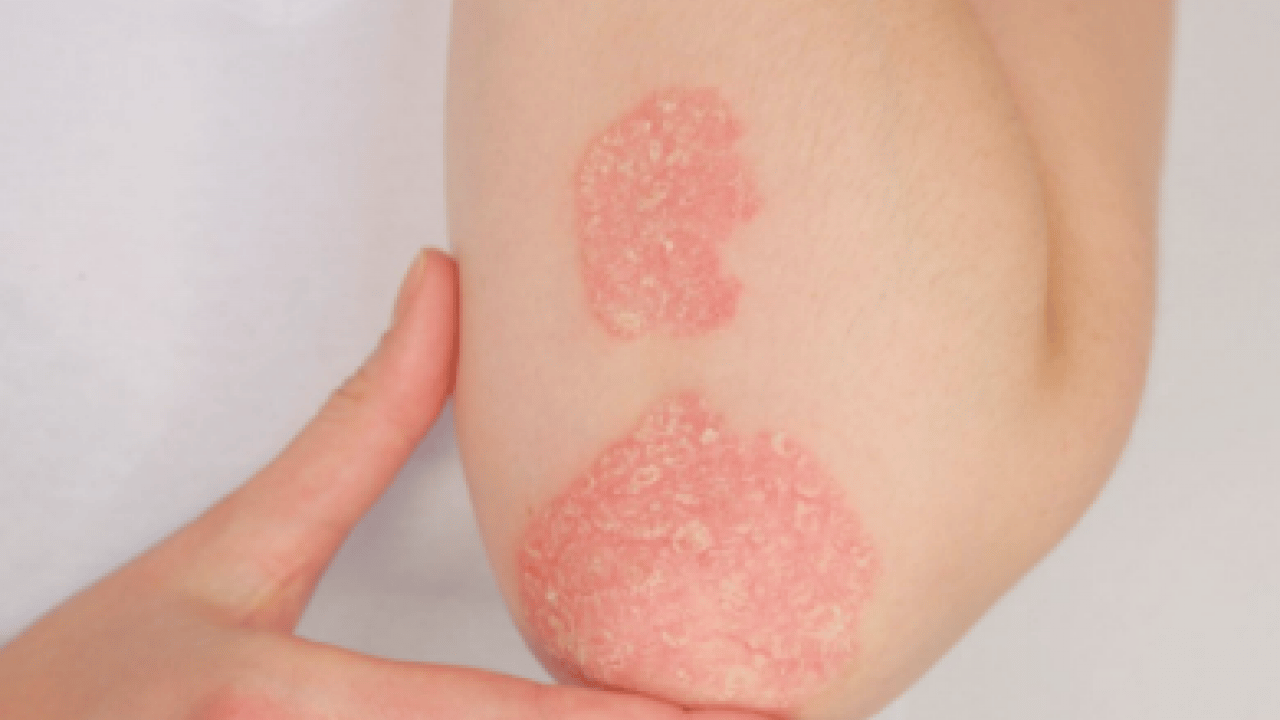 Foto - Şeker mekanizmasını bilim insanları keşfetti: Etkisini artırıyor! Sedef hastalığının ardındaki şaşırtıcı araştırma