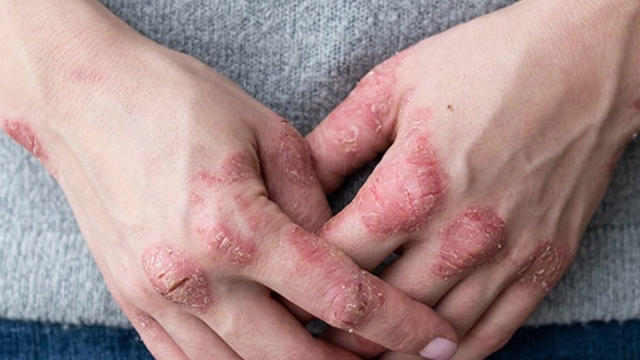 Foto - Şeker mekanizmasını bilim insanları keşfetti: Etkisini artırıyor! Sedef hastalığının ardındaki şaşırtıcı araştırma