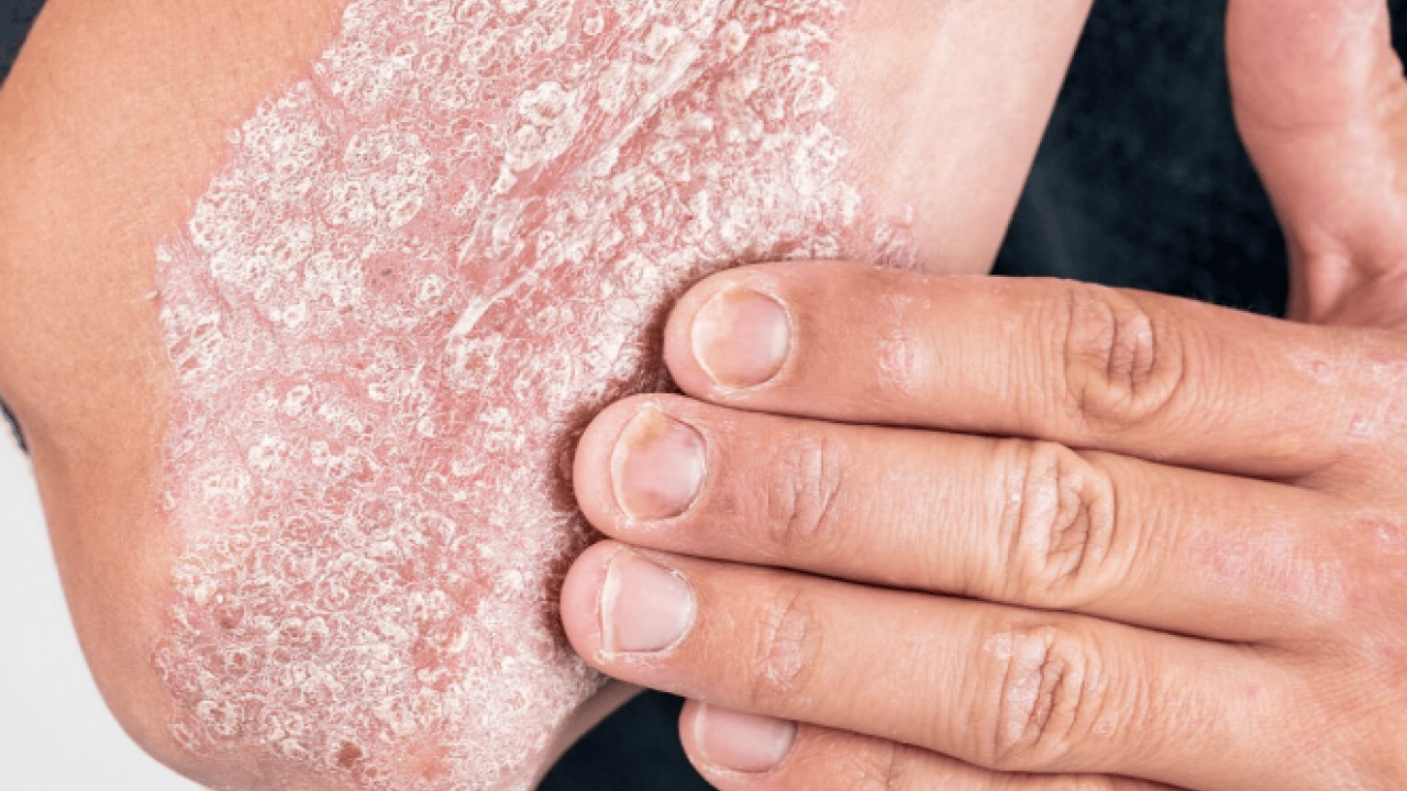 Foto - Şeker mekanizmasını bilim insanları keşfetti: Etkisini artırıyor! Sedef hastalığının ardındaki şaşırtıcı araştırma