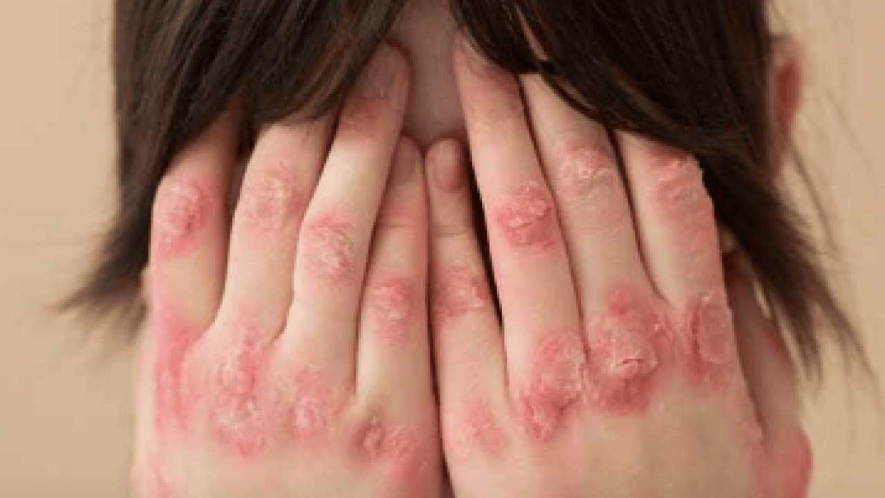 Foto - Şeker mekanizmasını bilim insanları keşfetti: Etkisini artırıyor! Sedef hastalığının ardındaki şaşırtıcı araştırma