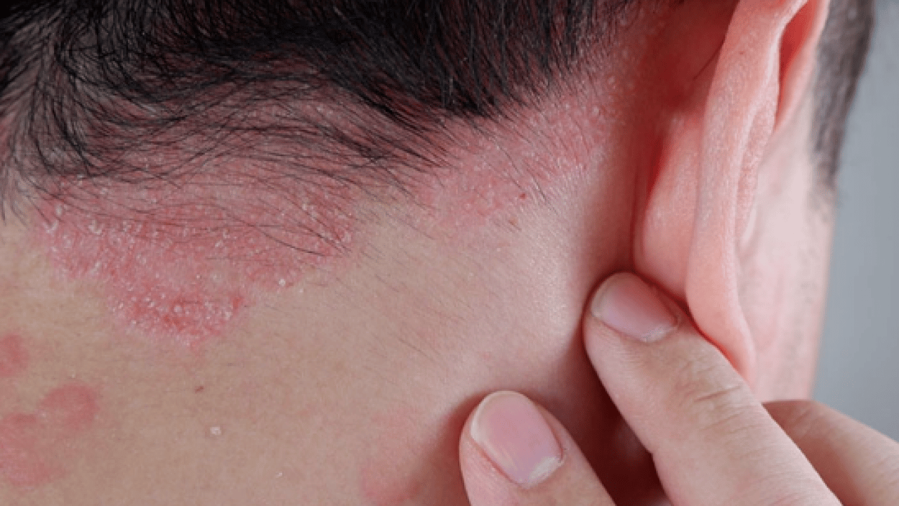 Şeker mekanizmasını bilim insanları keşfetti: Etkisini artırıyor! Sedef hastalığının ardındaki şaşırtıcı araştırma