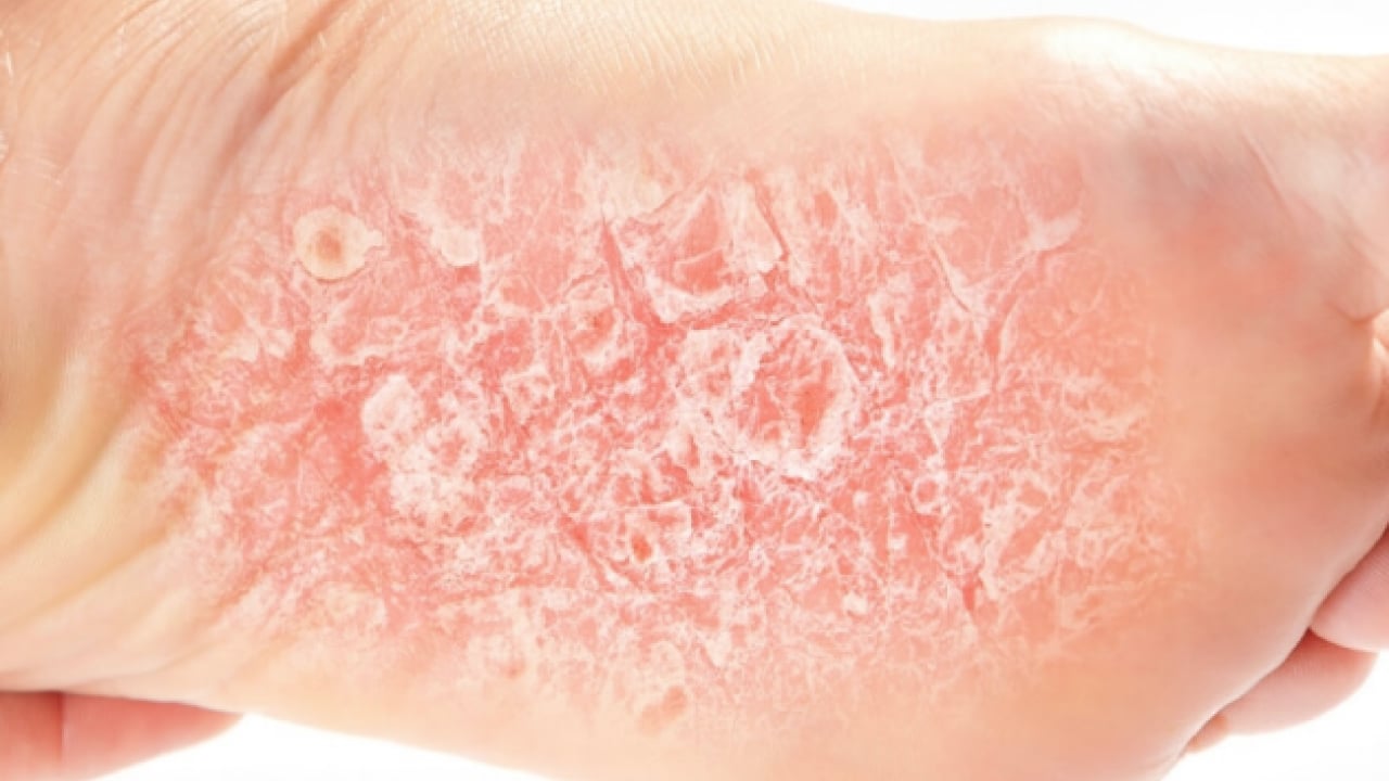 Foto - Şeker mekanizmasını bilim insanları keşfetti: Etkisini artırıyor! Sedef hastalığının ardındaki şaşırtıcı araştırma