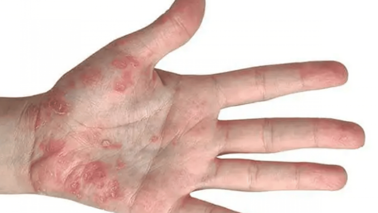 Foto - Şeker mekanizmasını bilim insanları keşfetti: Etkisini artırıyor! Sedef hastalığının ardındaki şaşırtıcı araştırma