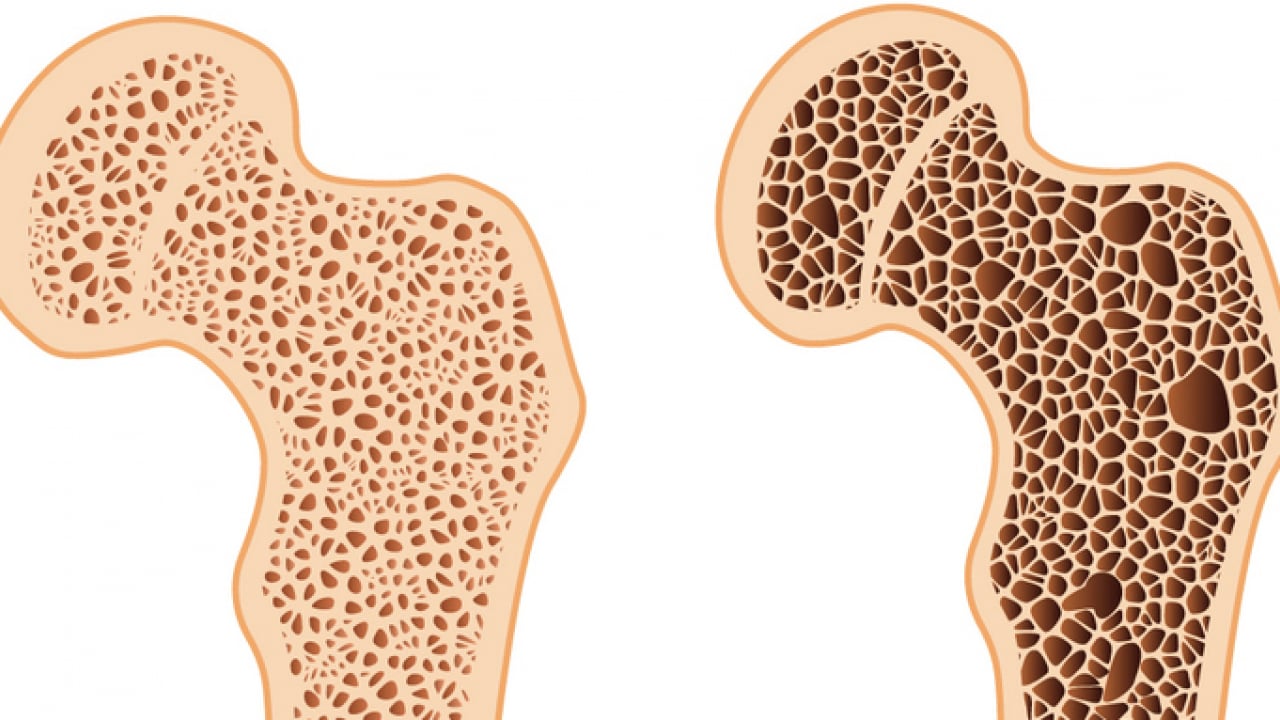 Foto - Sessiz tehlike: Osteoporoz! Kemik erimesi olayının ehemmiyetini algılamalısınız...