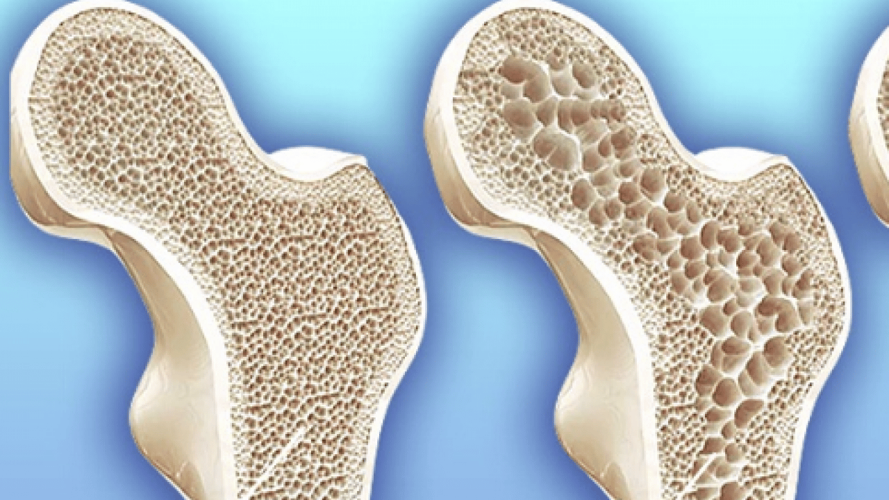 Foto - Sessiz tehlike: Osteoporoz! Kemik erimesi olayının ehemmiyetini algılamalısınız...