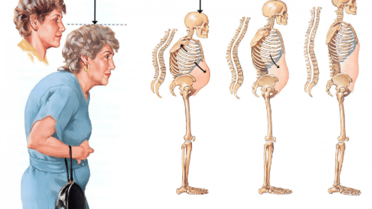 Foto - Sessiz tehlike: Osteoporoz! Kemik erimesi olayının ehemmiyetini algılamalısınız...