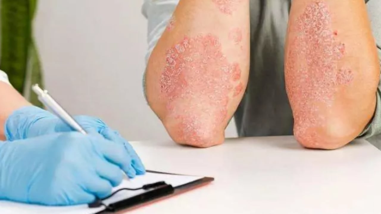 Foto - SGK listeyi paylaştı: Bu hastalığı olanlar malulen emekli olacak!