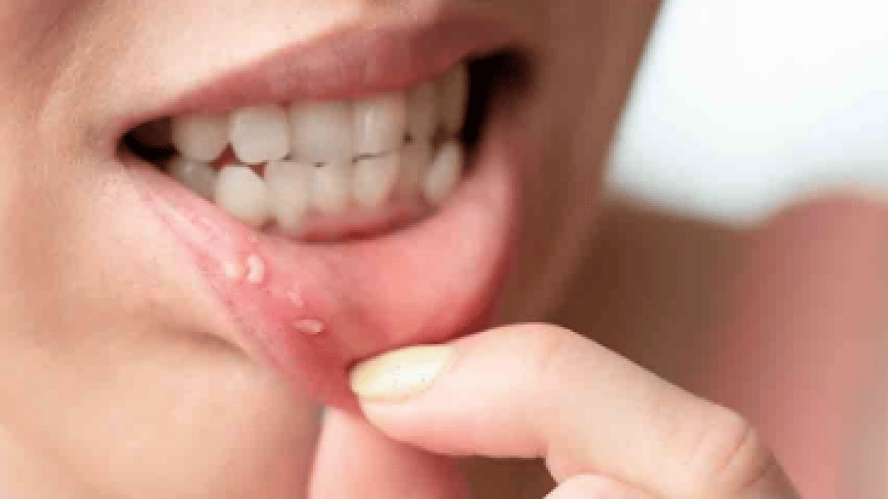 Foto - Sialendoskopi yöntemi öne çıktı: Susuzluk değil, uyarı: Ağız kuruluğu hafife alınmamalı