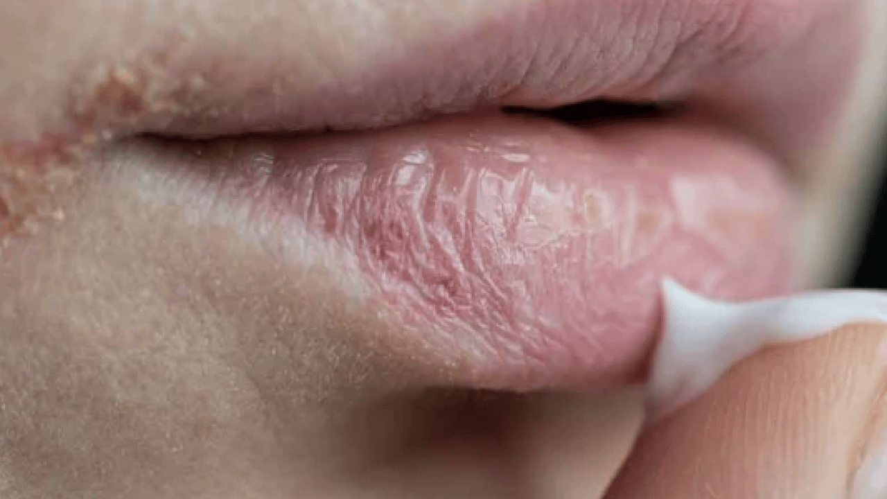 Foto - Sialendoskopi yöntemi öne çıktı: Susuzluk değil, uyarı: Ağız kuruluğu hafife alınmamalı