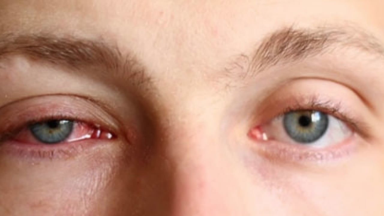 Foto - Sıcak havalar geldikçe... Bahar alerjisi gözleri etkiler mi? Bunu ihmal etmeyin yoksa?!?