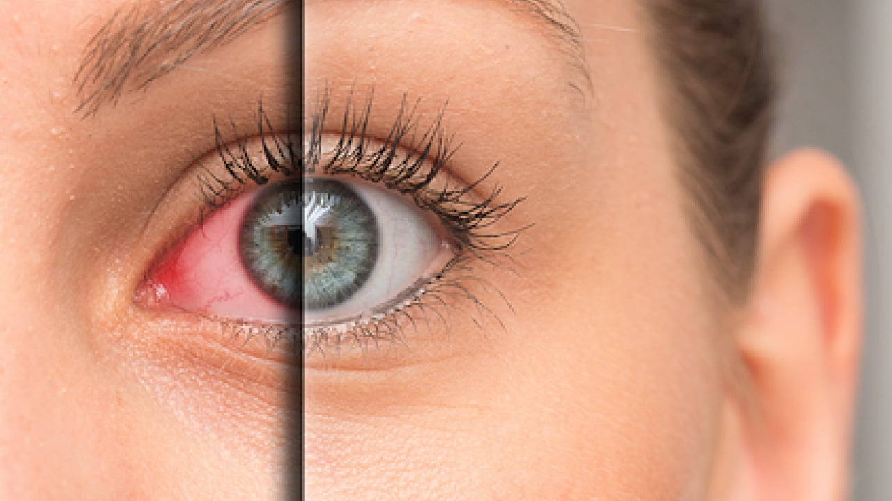 Foto - Sıcak havalar geldikçe... Bahar alerjisi gözleri etkiler mi? Bunu ihmal etmeyin yoksa?!?