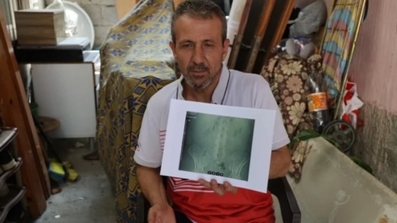 Foto - Şifa bulmaya gitti, yürüyemez hale geldi! Ameliyatta belinde panç unuttular
