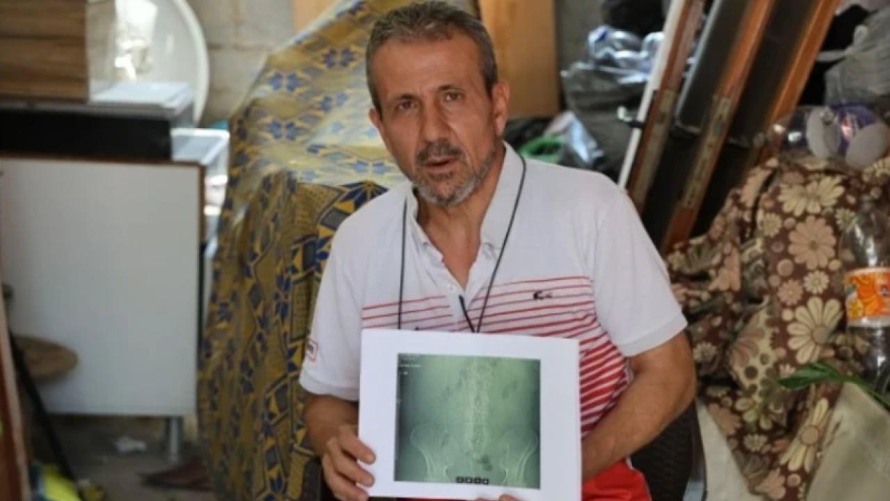 Foto - Şifa bulmaya gitti, yürüyemez hale geldi! Ameliyatta belinde panç unuttular