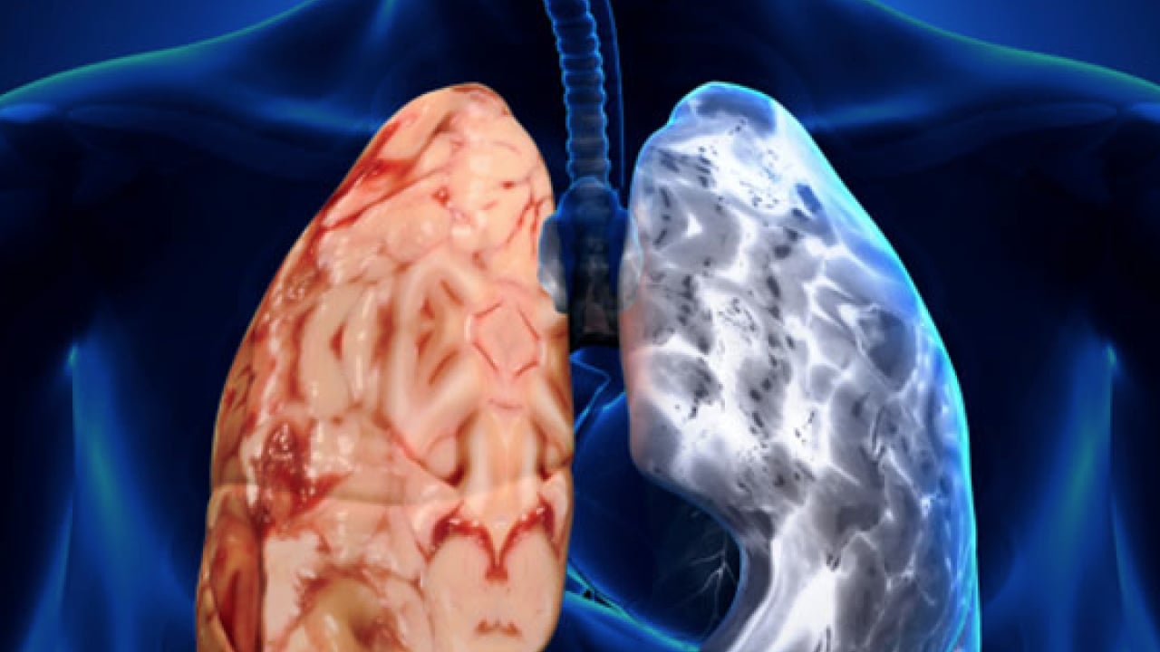 Foto - Sigara içen koah adayı! Uzmanı uyardı, önlemini al tavsiyesi verdi! Sigara kullananlar yandı zarar veriyor!