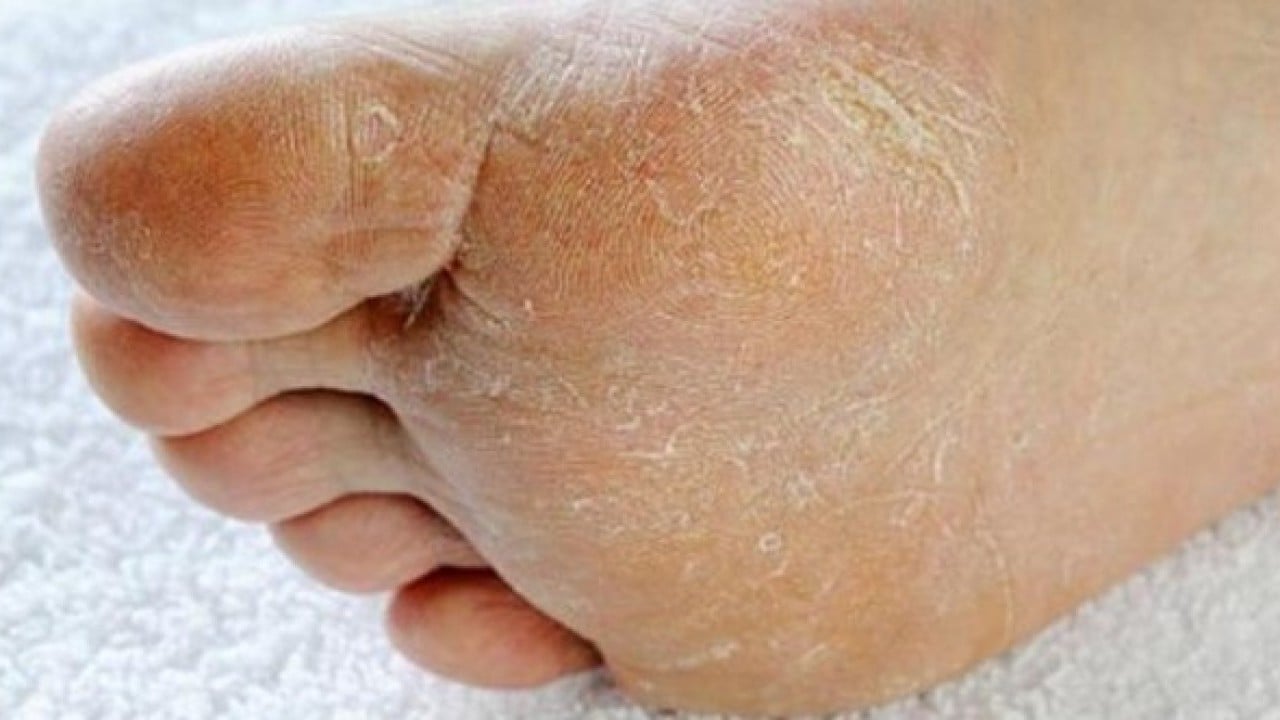 Foto - Sırrı ortaya çıktı! Nasır tutmuş topukları pamuk gibi yapıyor