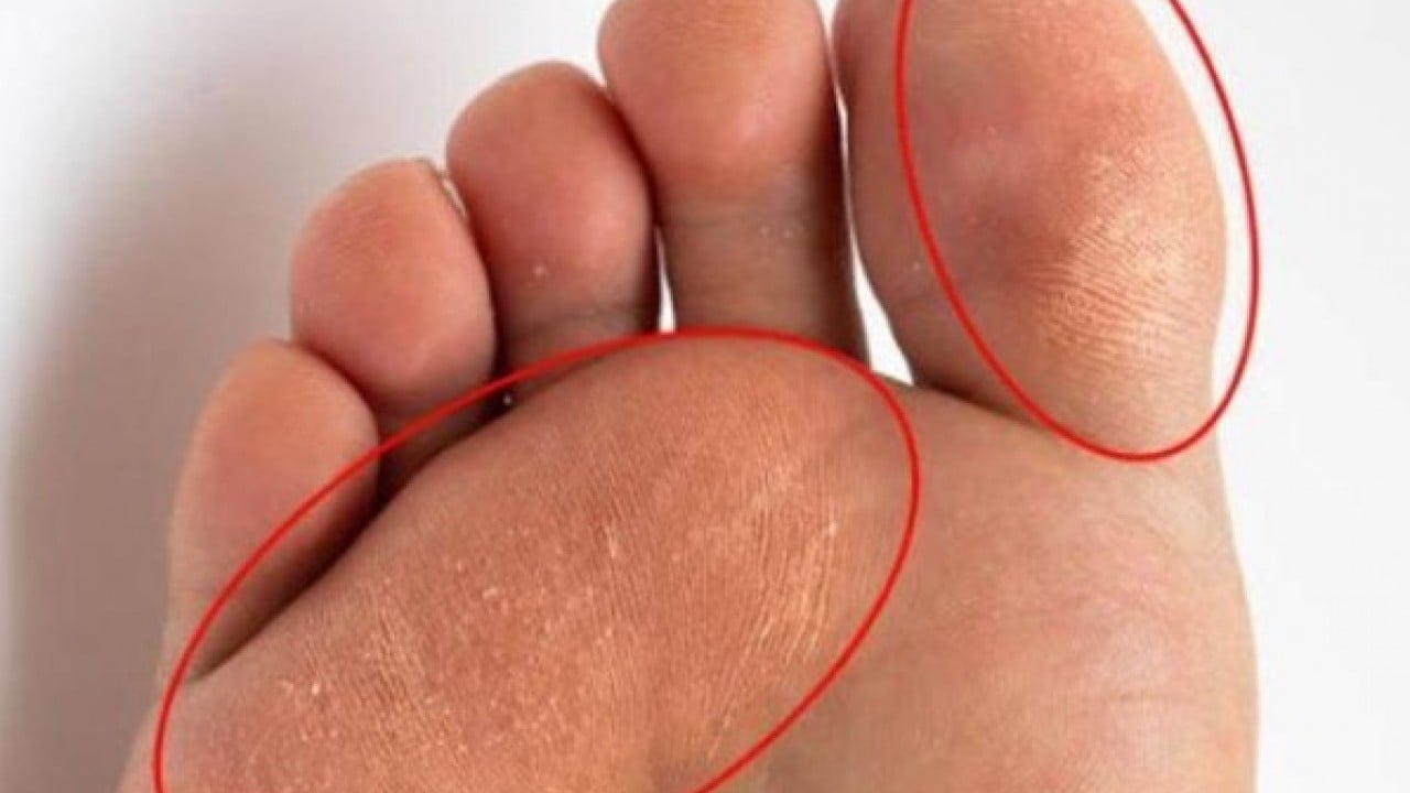 Foto - Sırrı ortaya çıktı! Nasır tutmuş topukları pamuk gibi yapıyor