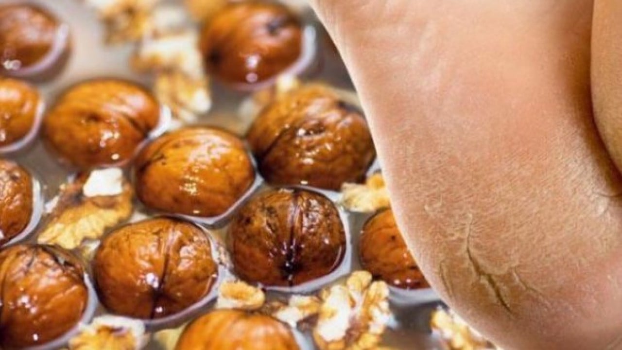 Sırrı ortaya çıktı! Nasır tutmuş topukları pamuk gibi yapıyor