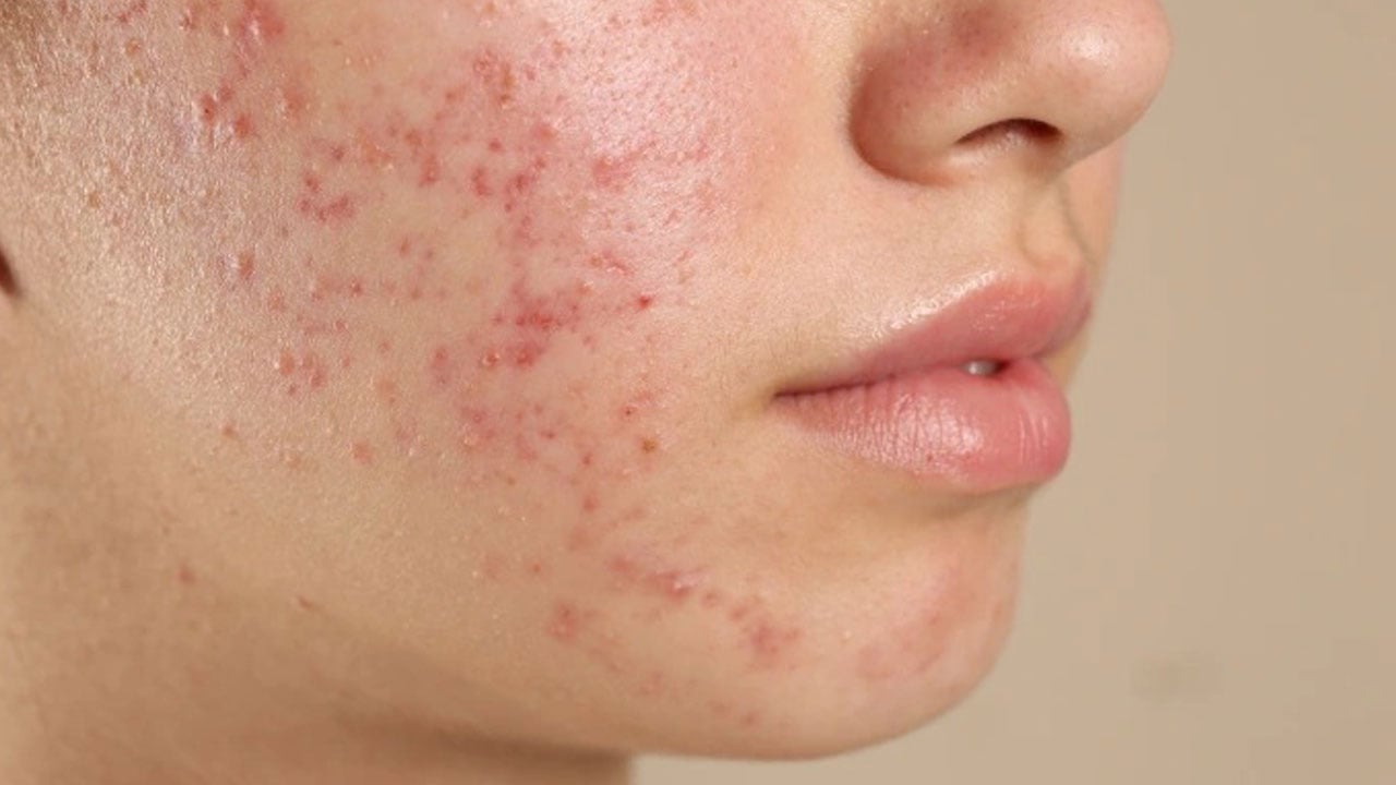 Sivilceler neden geçmiyor? Akne oluşumuna yol açan 7 hatalı alışkanlık! 
