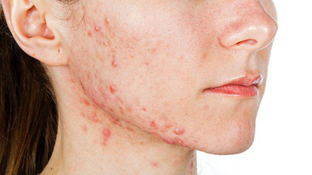 Foto - Sivilceler neden geçmiyor? Akne oluşumuna yol açan 7 hatalı alışkanlık! 