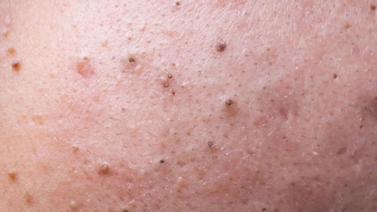 Foto - Sivilceler neden geçmiyor? Akne oluşumuna yol açan 7 hatalı alışkanlık! 