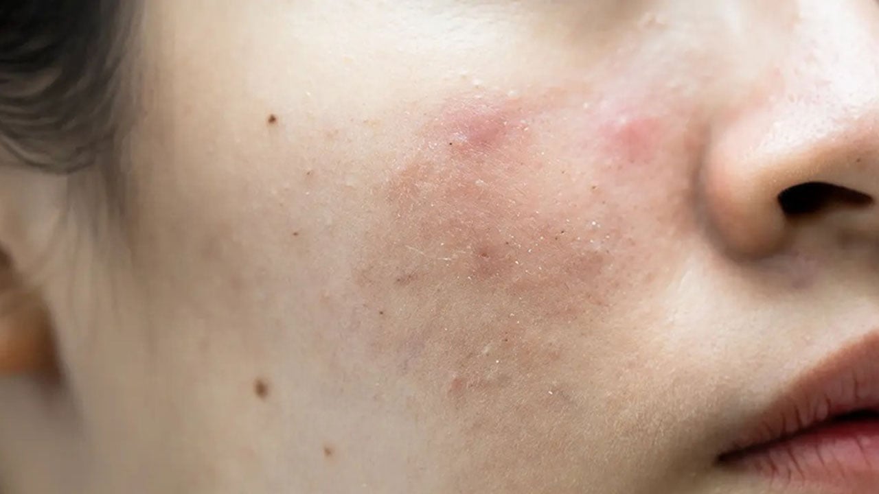 Foto - Sivilceler neden geçmiyor? Akne oluşumuna yol açan 7 hatalı alışkanlık! 