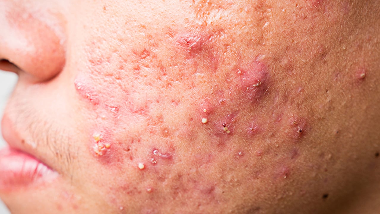 Foto - Sivilcenin kökünü kazıyor: Maya maskesi pullanıp dökülmeye mani oluyor! Hoşluk maskesi herkesin yeni favorisi