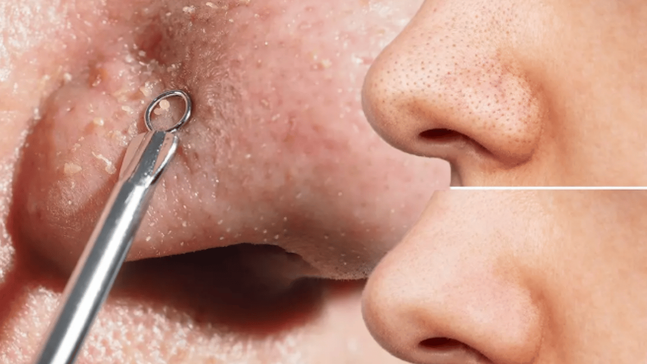 Siyah noktaları 5 günde yok ediyor: Tarçınla karıştırıp sürün! 