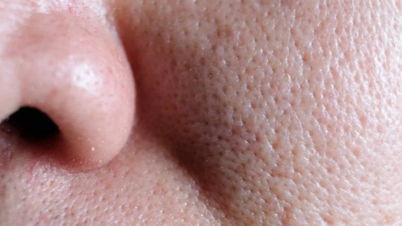 Foto - Siyah noktaları 5 günde yok ediyor: Tarçınla karıştırıp sürün! 