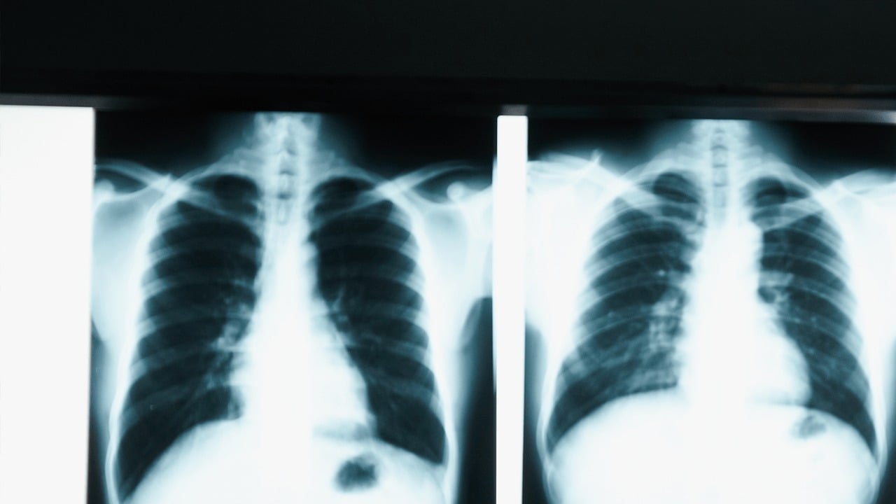 Foto - Soğuk havaya karşı kalkan görevi gören bu vitamin akciğerleri koruyabilir! Bilim insanları açıkladı, duyan şok yaşıyor