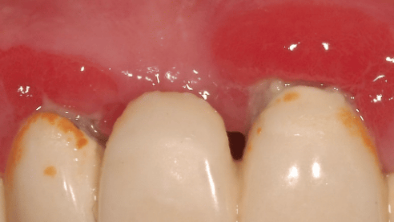 Foto - Şok gerçek! Ağızdaki düşman ortaya çıktı: Kalp ve beyin sağlığını tehdit ediyor! Hemen önlem almalıyız bekleyen kaybeder