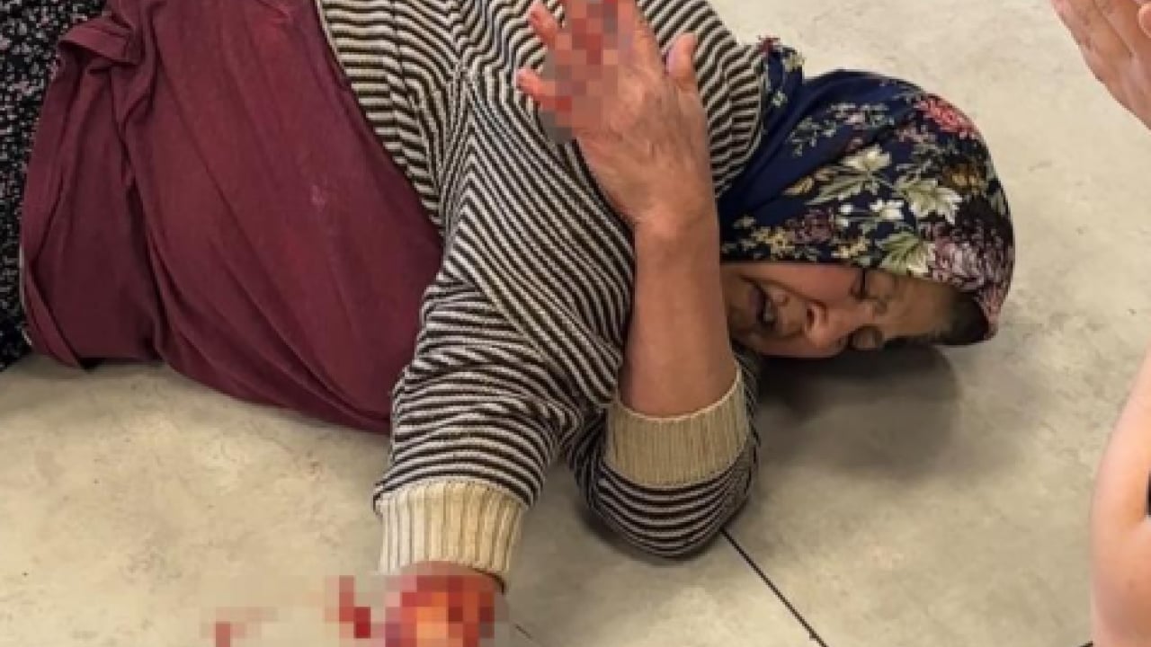 Foto - Sokak terörünün son kurbanı: Gözü dönmüş köpek kadının kolunu kopardı
