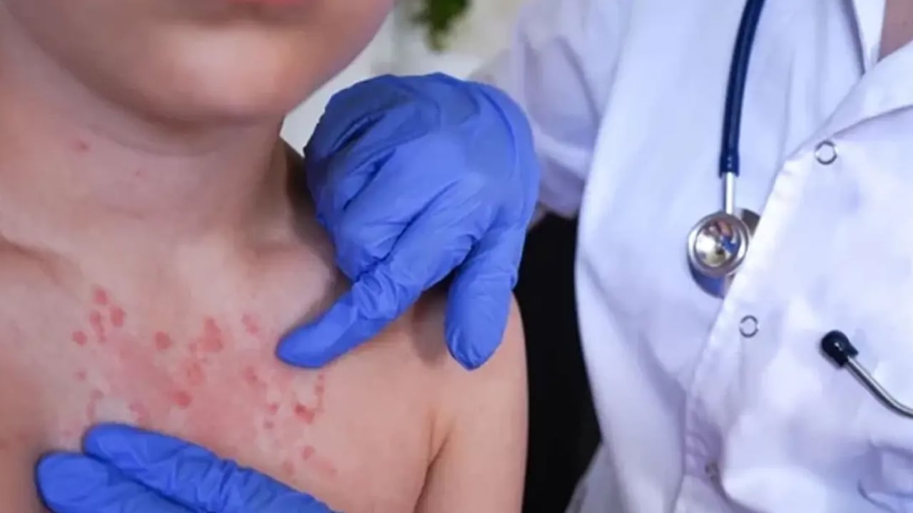 Foto - Son 30 yılda vakalar pik yaptı! Prof. Dr. Kritik mesajı verdi: 3 yıl kadar sürüyor, bir anda ortaya çıktı kötü haber 