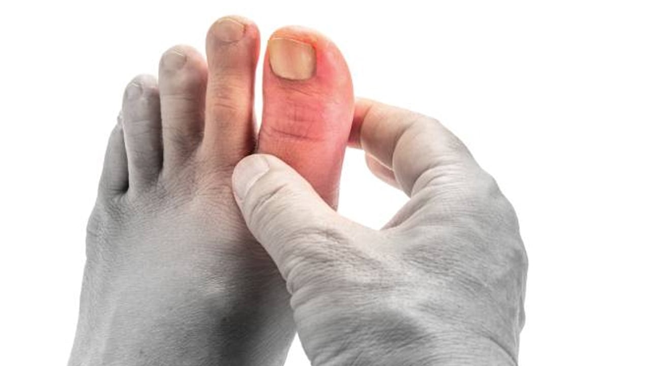 Foto - Uzmanı sosyal sitelerinde dolaşan Gut hastalığı konusunda uyarıyor! Sakın inanmayın... Uzmanından uyarı 