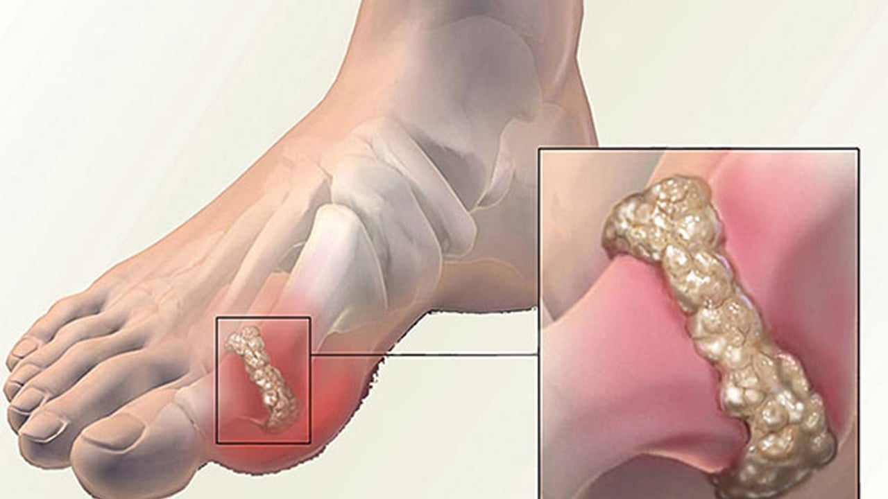 Foto - Uzmanı sosyal sitelerinde dolaşan Gut hastalığı konusunda uyarıyor! Sakın inanmayın... Uzmanından uyarı 