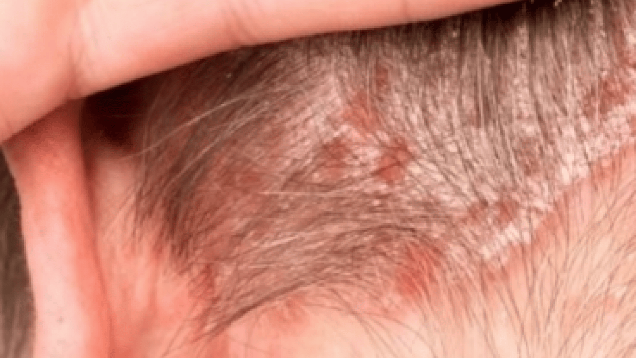 Foto - Egzamayı 3 günde bitiriyor! 1 damlasını karıştırın, sürün