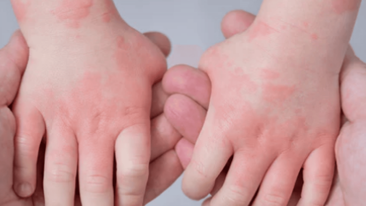 Foto - Egzamayı 3 günde bitiriyor! 1 damlasını karıştırın, sürün